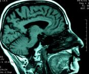 Brain scans may improve dementia diagnosis, treatment