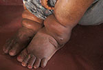 Photo of swollen feet