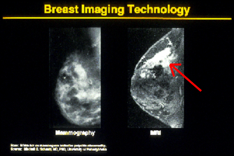 On the left is a picture of a mammogram of a woman with a breast lump. The location of the breast lump is indicated by the white dot on the mammogram. The mammogram failed to show the large breast cancer (indicated with the arrow), which was clearly seen on the MRI study of the breast (picture on the right).