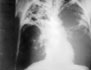 x-ray of the lungs